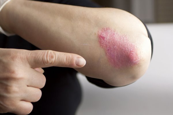 European approval for UCB’s Bimzelx for plaque psoriasis
