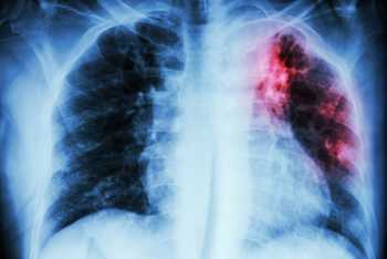 NICE recommends use of new life extending lung cancer treatment