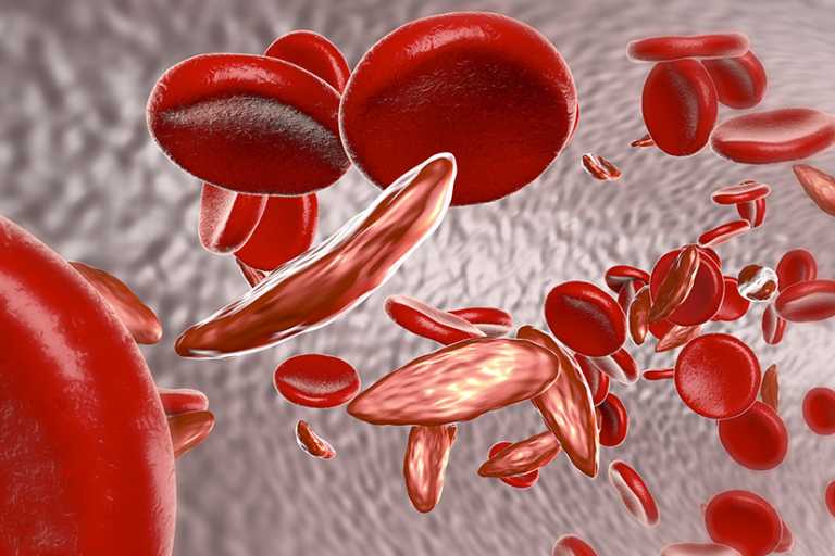 MHRA grants marketing authorization for GBT’s Oxbryta for treatment of hemolytic anemia in patients with sickle cell disease 12 years and older