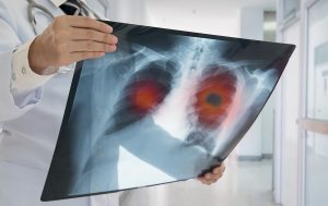 Lung cancer drug could improve survival rates for bladder cancer patients undergoing chemotherapy
